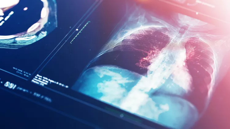 Multifocal Pneumonia